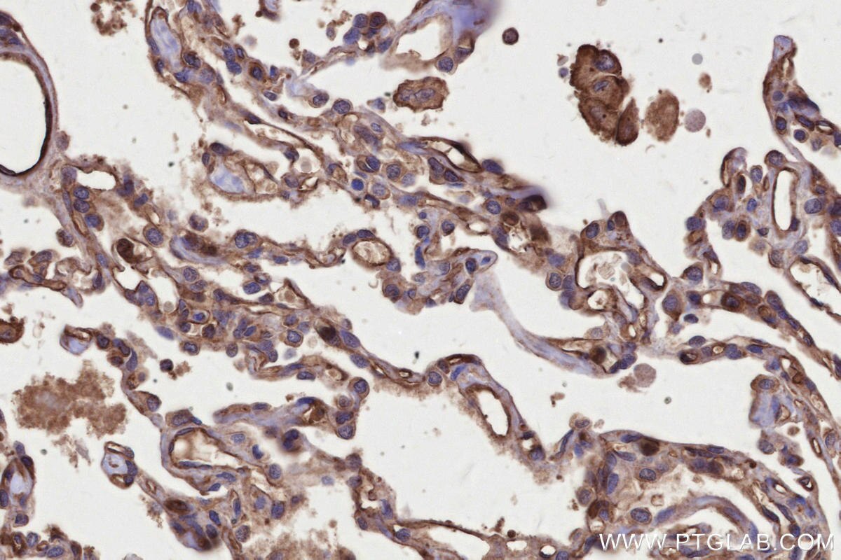 IHC staining of human lung cancer using 29971-1-AP Immunohistochemistry (IHC) staining of human lung cancer tissue using TRPV3 Polyclonal antibody (29971-1-AP)