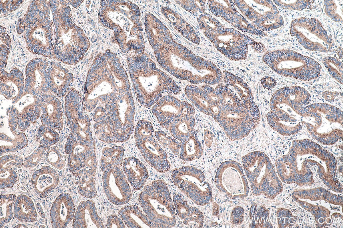 Immunohistochemistry (IHC) staining of human colon cancer tissue using TRUB2 Polyclonal antibody (19891-1-AP)