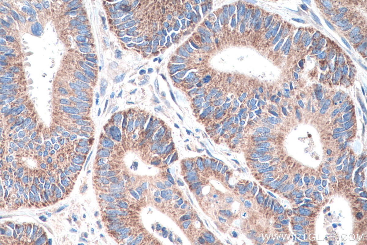 Immunohistochemistry (IHC) staining of human colon cancer tissue using TRUB2 Polyclonal antibody (19891-1-AP)