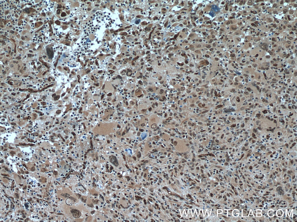 Immunohistochemistry (IHC) staining of human gliomas tissue using TSC22D1 Polyclonal antibody (10214-1-Ig)