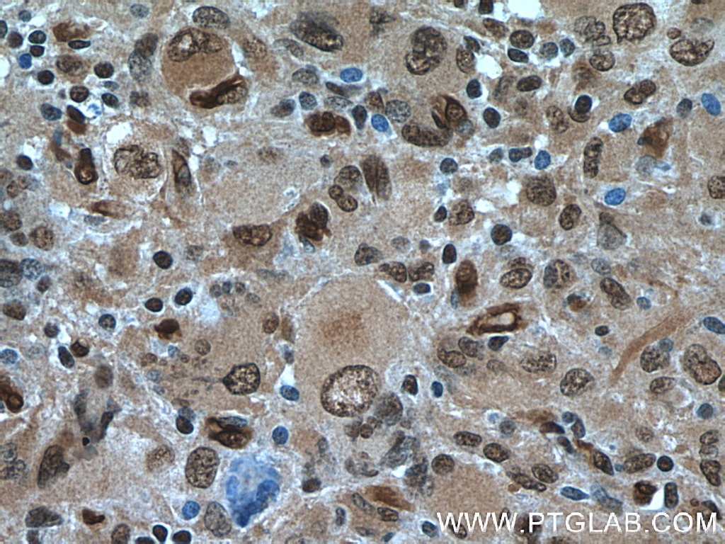 Immunohistochemistry (IHC) staining of human gliomas tissue using TSC22D1 Polyclonal antibody (10214-1-Ig)