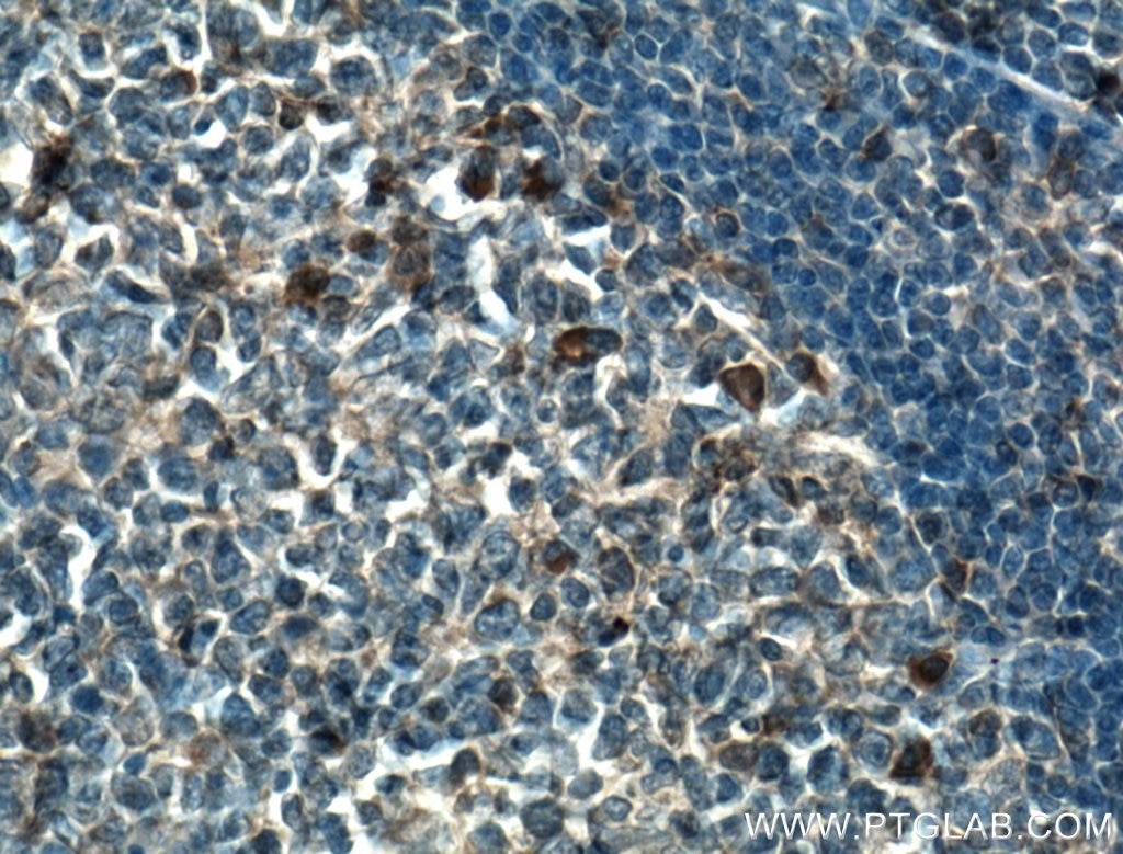 Immunohistochemistry (IHC) staining of human tonsillitis tissue using TSEPA Polyclonal antibody (27415-1-AP)