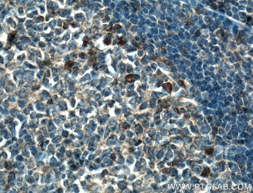 IHC staining of human tonsillitis using 27415-1-AP