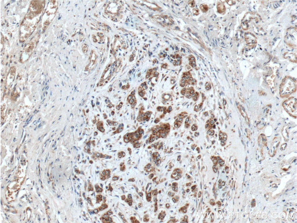 Immunohistochemistry (IHC) staining of human colon cancer tissue using TSFM Polyclonal antibody (11701-1-AP)