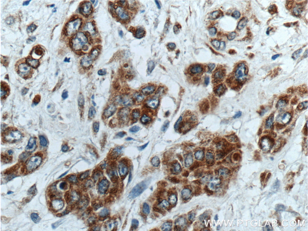 Immunohistochemistry (IHC) staining of human colon cancer tissue using TSFM Polyclonal antibody (11701-1-AP)