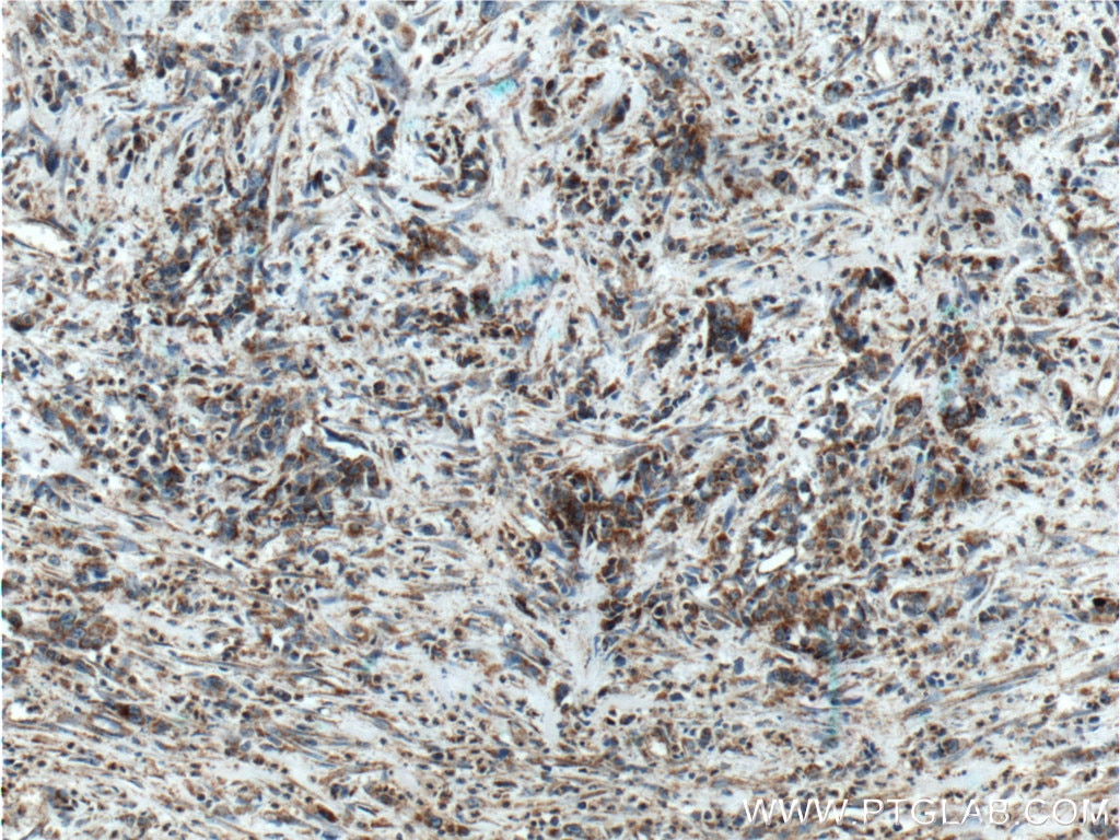 Immunohistochemistry (IHC) staining of human stomach cancer tissue using TSFM Polyclonal antibody (11701-1-AP)