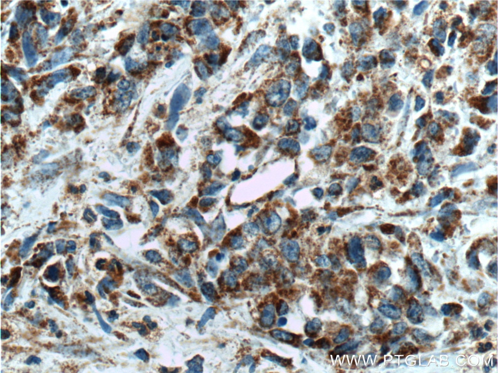 Immunohistochemistry (IHC) staining of human stomach cancer tissue using TSFM Polyclonal antibody (11701-1-AP)