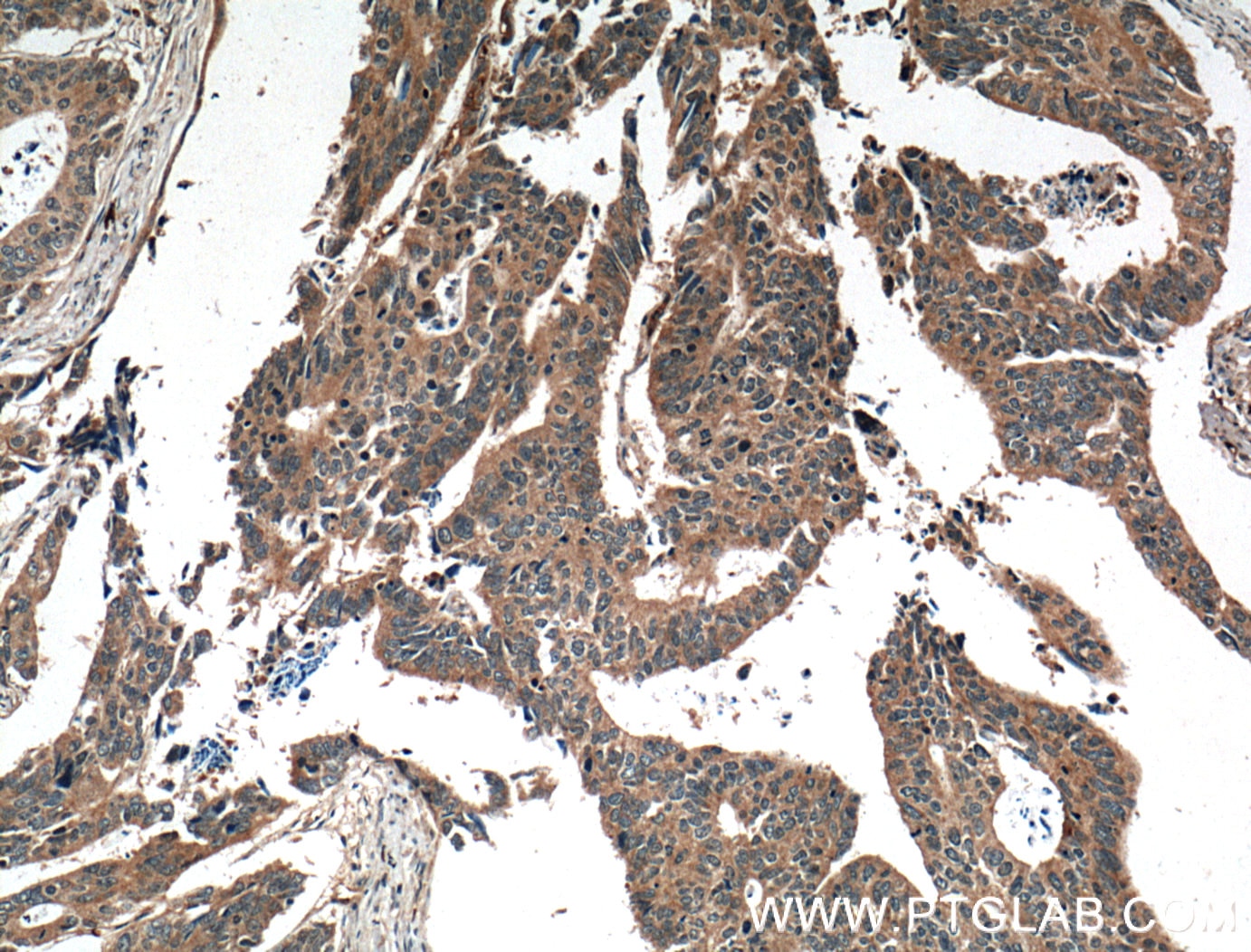 Immunohistochemistry (IHC) staining of human colon cancer tissue using TSG101 Polyclonal antibody (14497-1-AP)