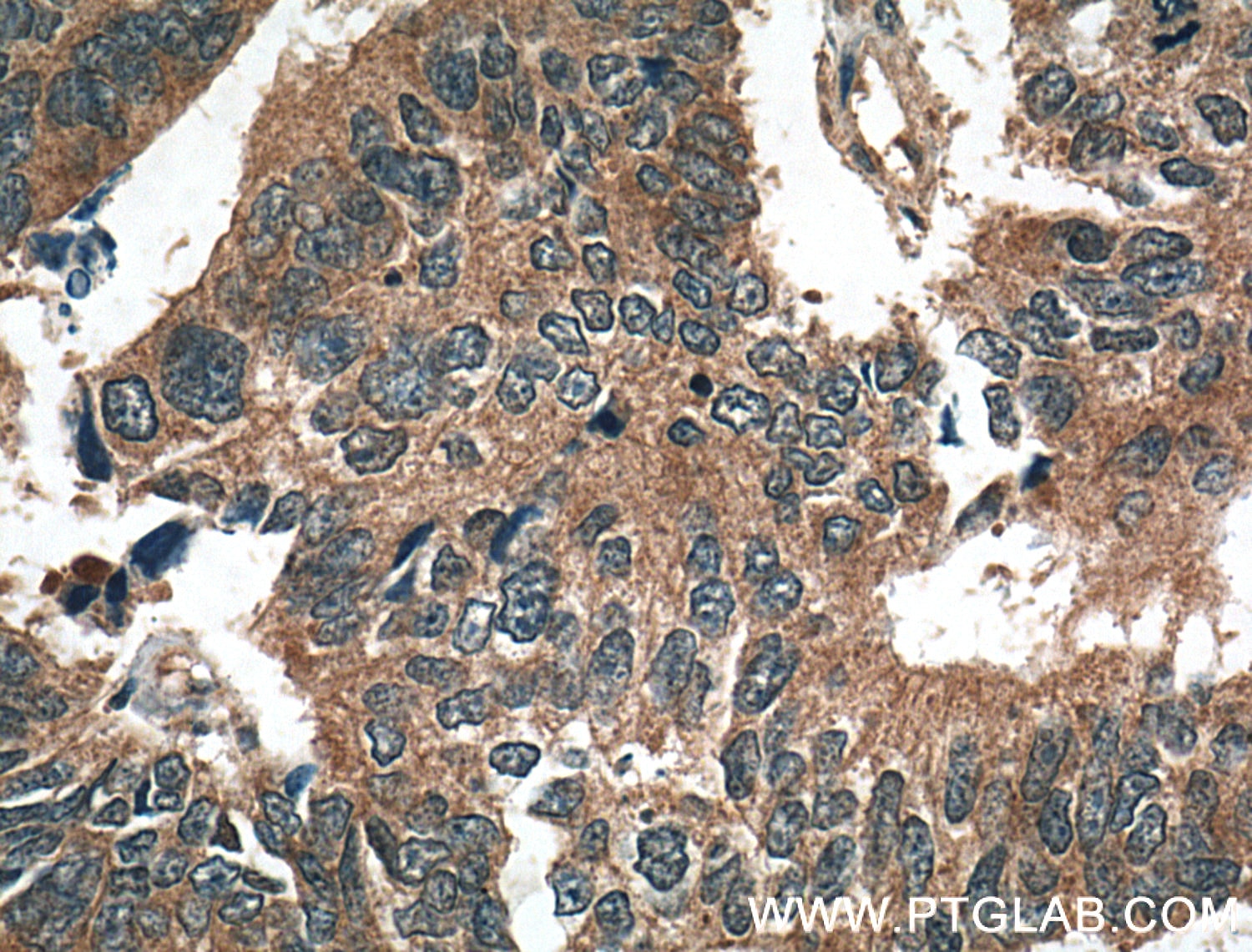 Immunohistochemistry (IHC) staining of human colon cancer tissue using TSG101 Polyclonal antibody (14497-1-AP)
