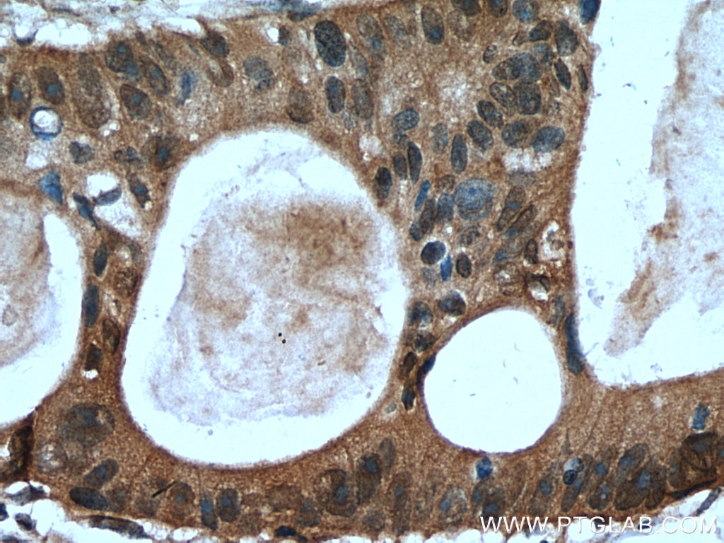 Immunohistochemistry (IHC) staining of human colon cancer tissue using TSG101 Polyclonal antibody (28283-1-AP)