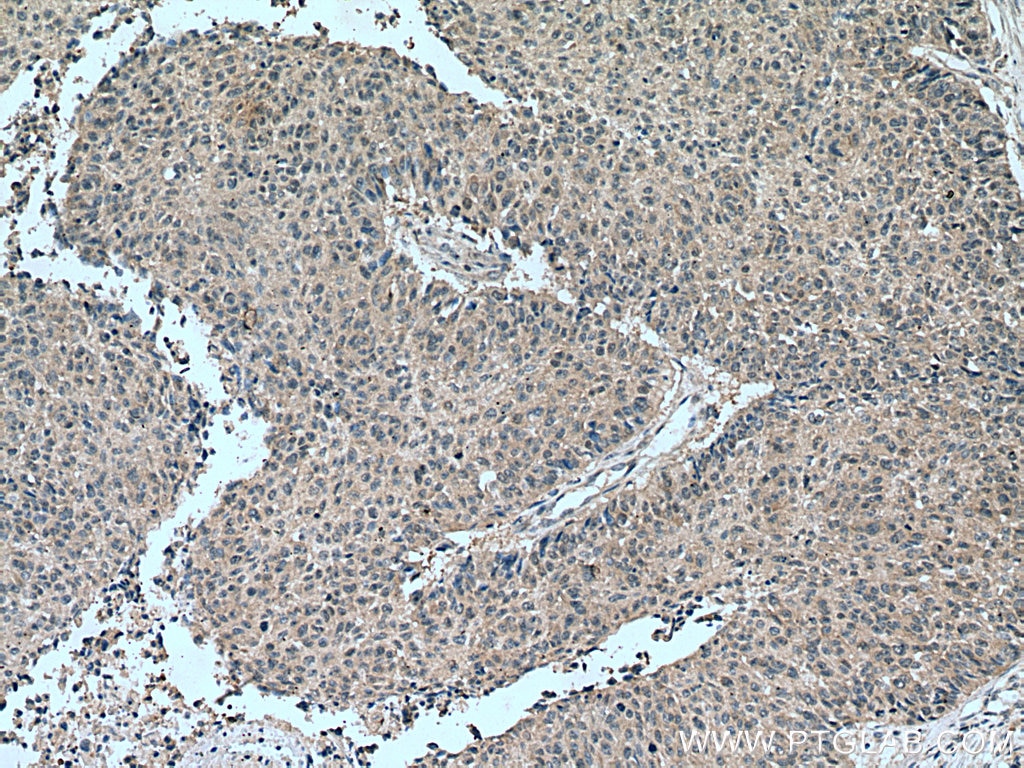 Immunohistochemistry (IHC) staining of human lung cancer tissue using TSG101 Polyclonal antibody (28283-1-AP)