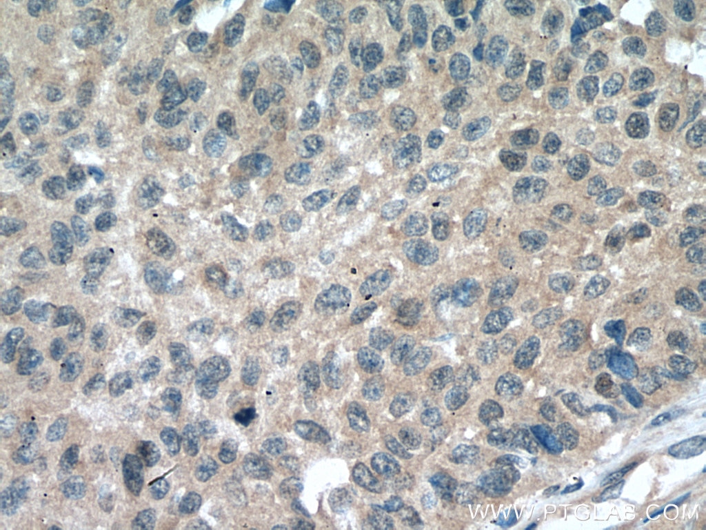 Immunohistochemistry (IHC) staining of human lung cancer tissue using TSG101 Polyclonal antibody (28283-1-AP)