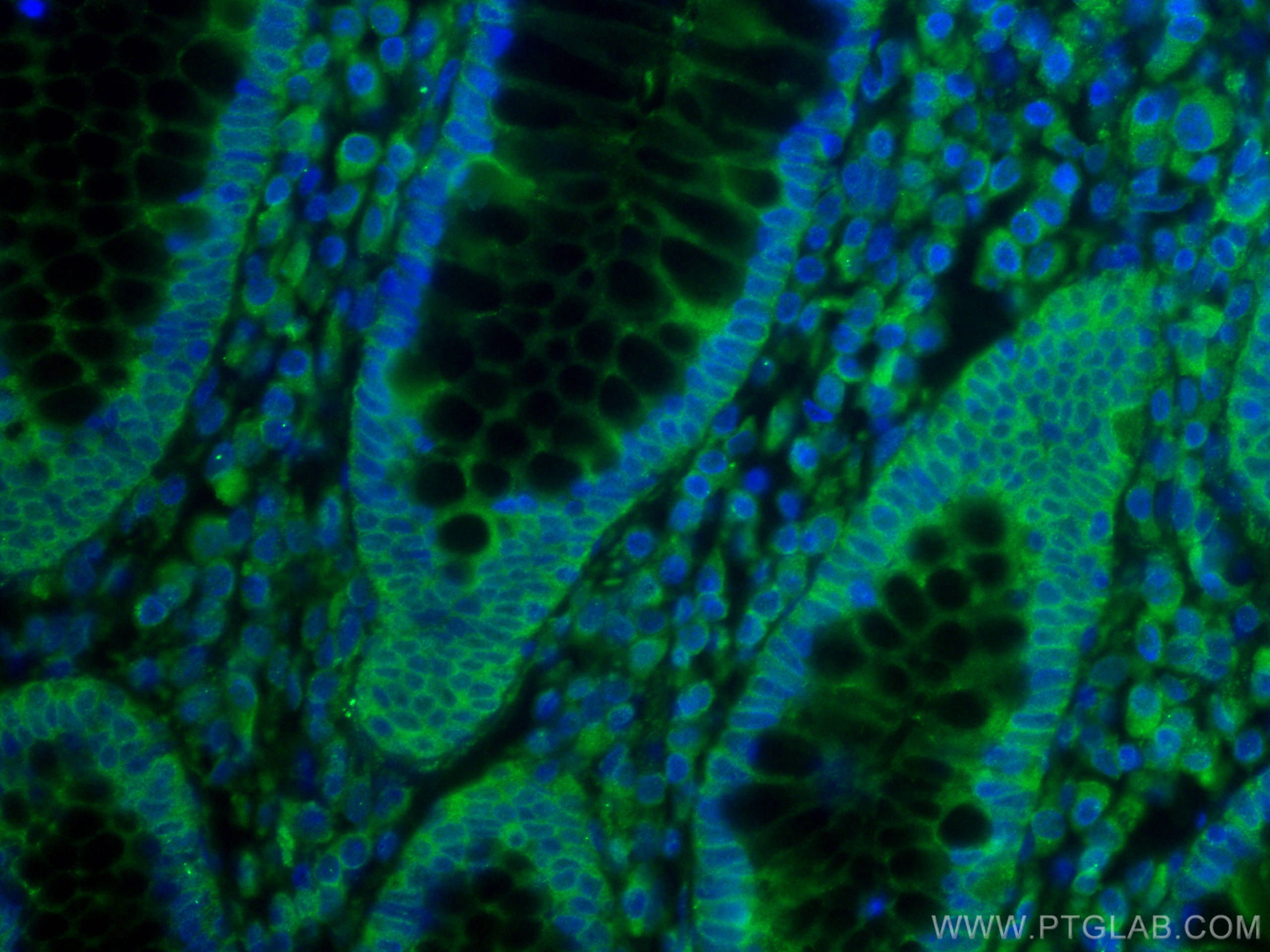 Immunofluorescence (IF) / fluorescent staining of human colon cancer tissue using TSG101 Monoclonal antibody (67381-1-Ig)