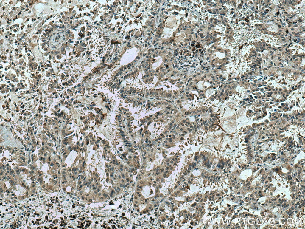 Immunohistochemistry (IHC) staining of human lung cancer tissue using TSG101 Monoclonal antibody (67381-1-Ig)