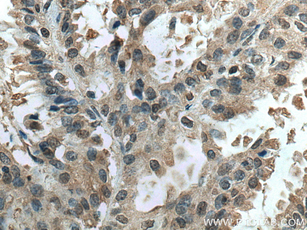 Immunohistochemistry (IHC) staining of human lung cancer tissue using TSG101 Monoclonal antibody (67381-1-Ig)