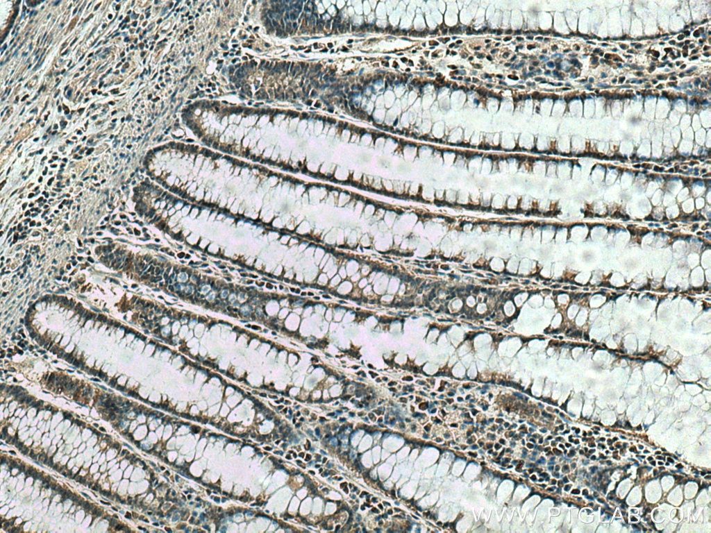 Immunohistochemistry (IHC) staining of human colon cancer tissue using TSG101 Monoclonal antibody (67381-1-Ig)