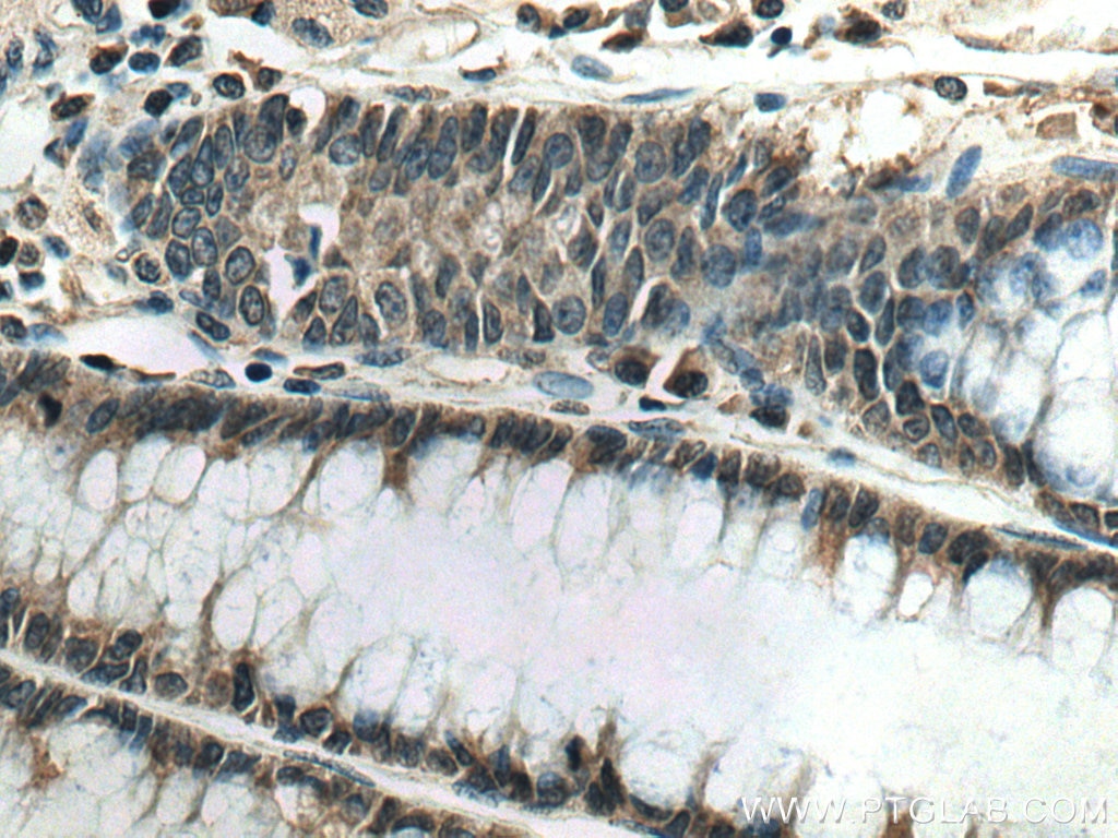 Immunohistochemistry (IHC) staining of human colon cancer tissue using TSG101 Monoclonal antibody (67381-1-Ig)