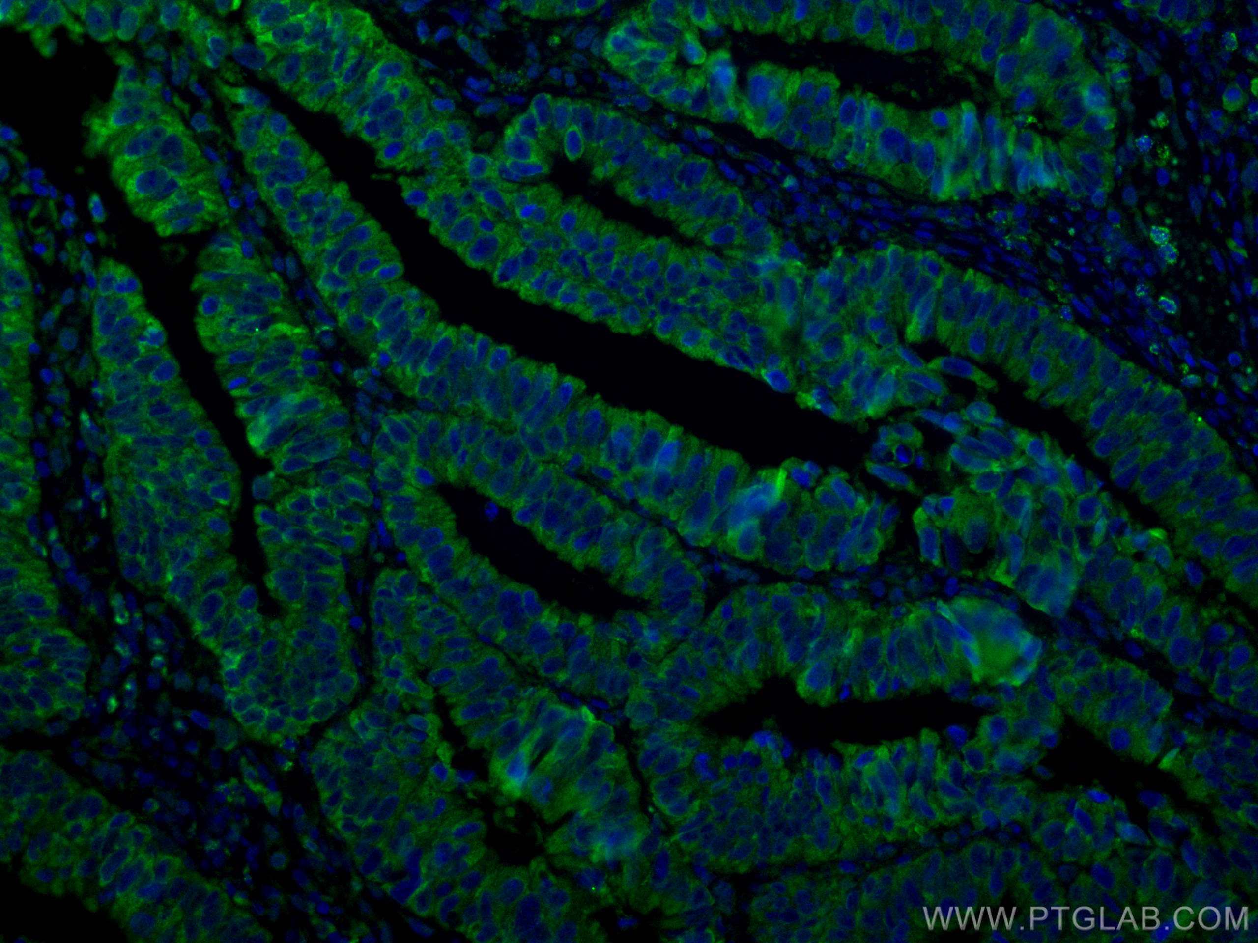 Immunofluorescence (IF) / fluorescent staining of human colon cancer tissue using CoraLite® Plus 488-conjugated TSG101 Monoclonal an (CL488-67381)