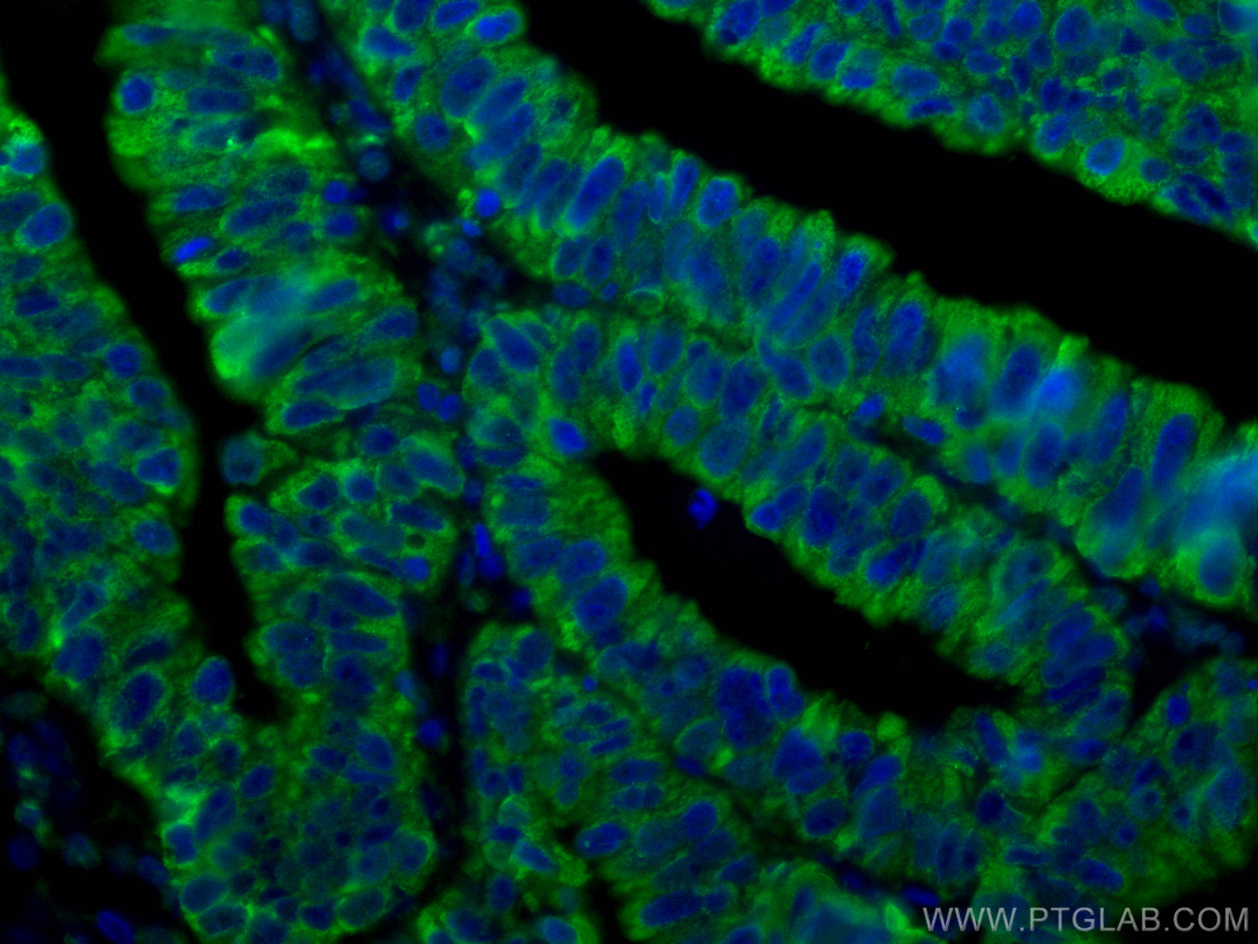 Immunofluorescence (IF) / fluorescent staining of human colon cancer tissue using CoraLite® Plus 488-conjugated TSG101 Monoclonal an (CL488-67381)