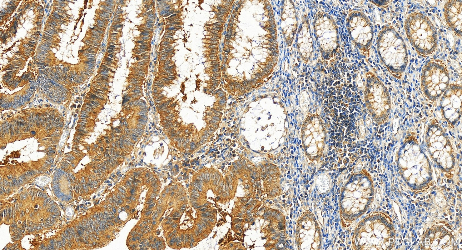 Immunohistochemistry (IHC) staining of human colon cancer tissue using Multi-rAb™ TSG101 Multi-Recombinant antibody (RMX00026)