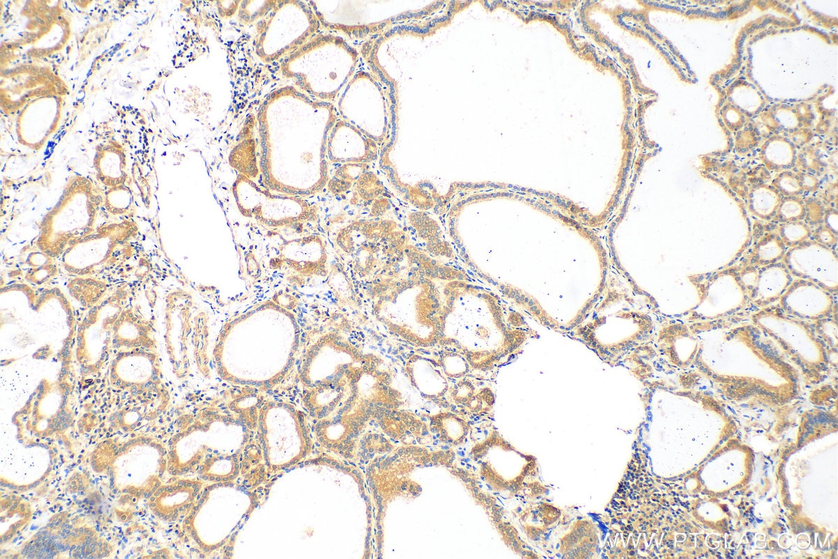 Immunohistochemistry (IHC) staining of human thyroid cancer tissue using TSHR Polyclonal antibody (14450-1-AP)