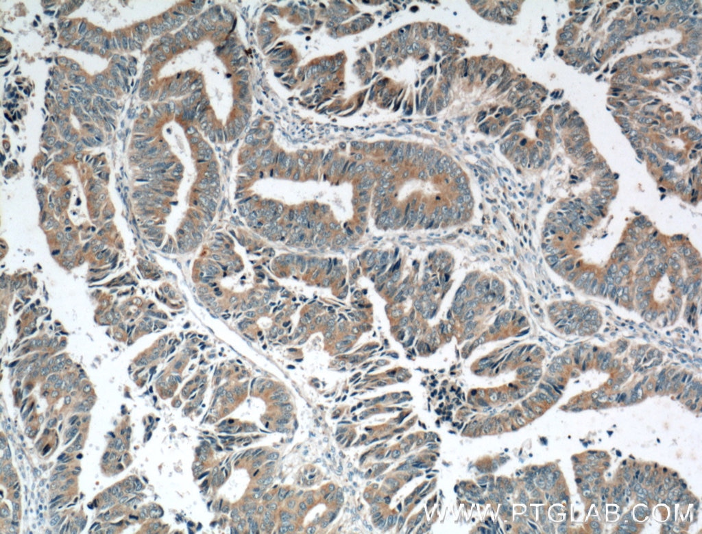 Immunohistochemistry (IHC) staining of human colon cancer tissue using TSKU Polyclonal antibody (12370-1-AP)