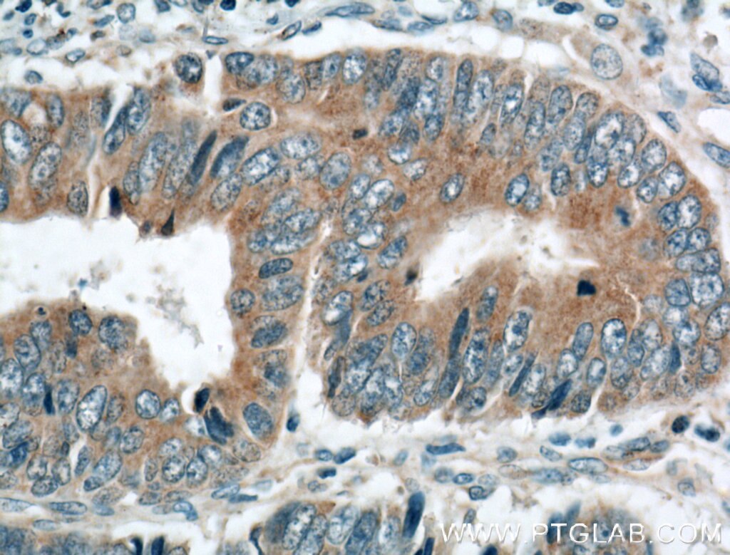 Immunohistochemistry (IHC) staining of human colon cancer tissue using TSKU Polyclonal antibody (12370-1-AP)