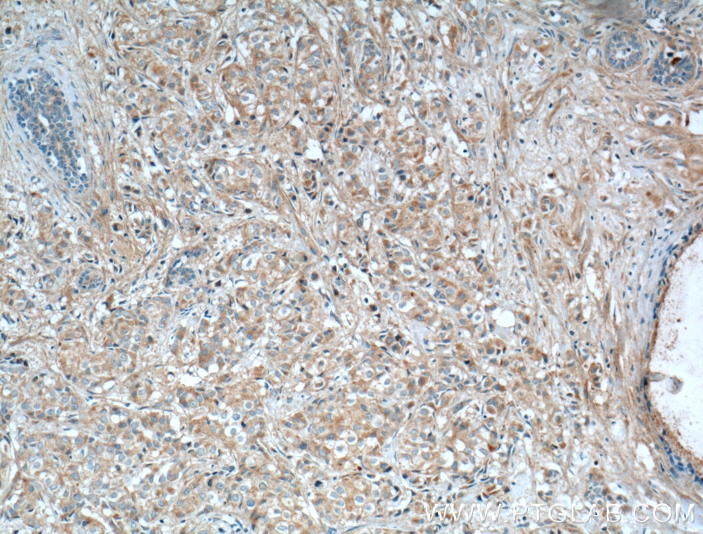 Immunohistochemistry (IHC) staining of human breast cancer tissue using TSKU Polyclonal antibody (12370-1-AP)
