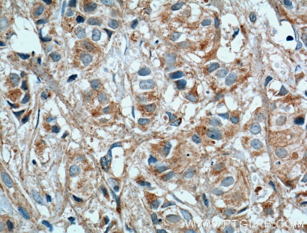 Immunohistochemistry (IHC) staining of human breast cancer tissue using TSKU Polyclonal antibody (12370-1-AP)