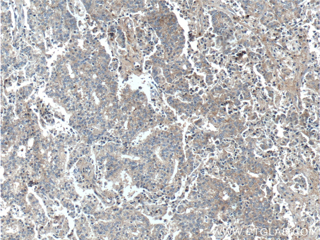 IHC staining of human prostate cancer using 13778-1-AP