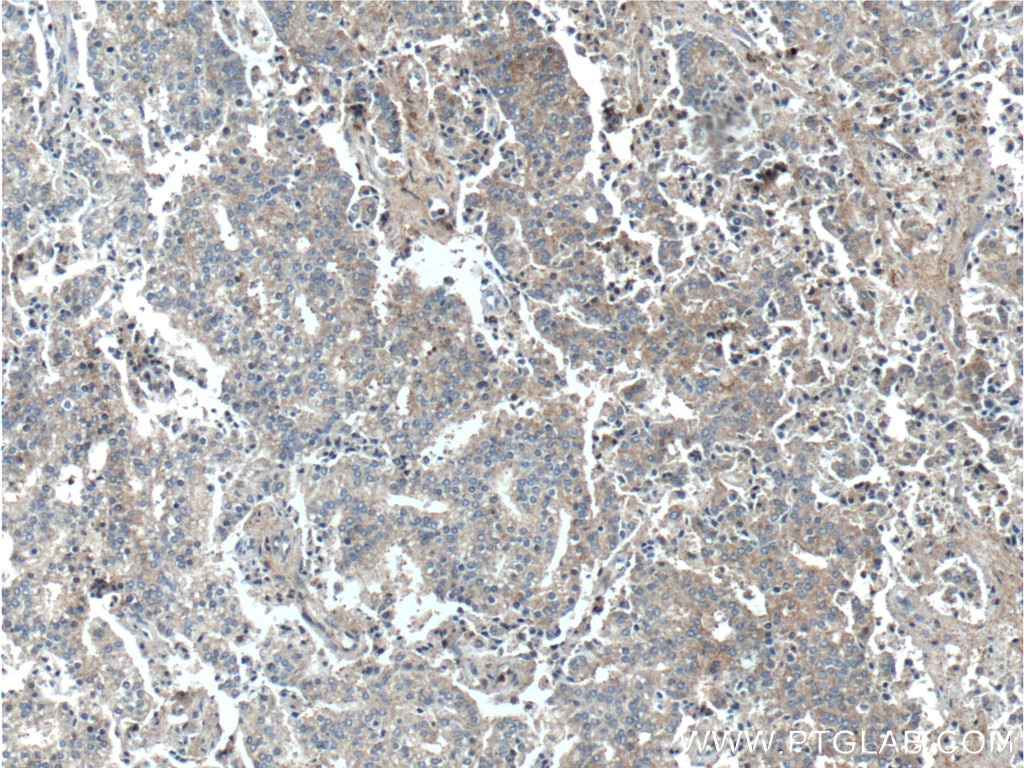 Immunohistochemistry (IHC) staining of human prostate cancer tissue using TSLP Polyclonal antibody (13778-1-AP)