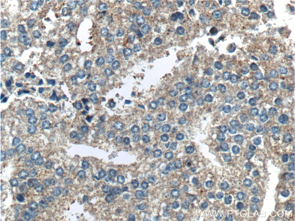 Immunohistochemistry (IHC) staining of human prostate cancer tissue using TSLP Polyclonal antibody (13778-1-AP)