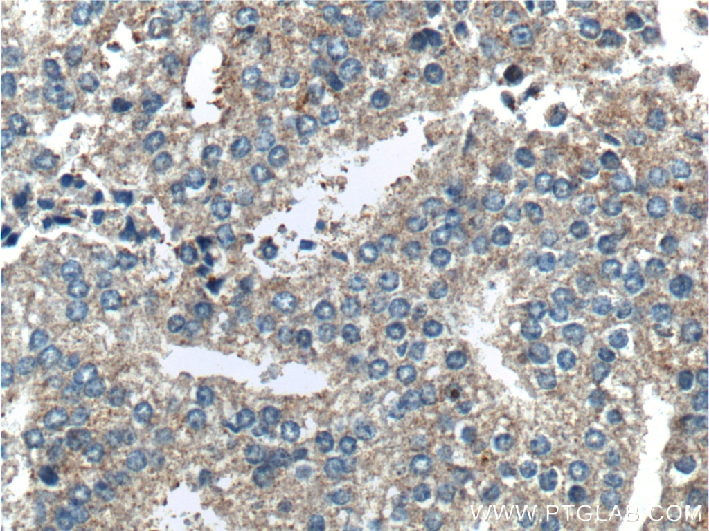 IHC staining of human prostate cancer using 13778-1-AP