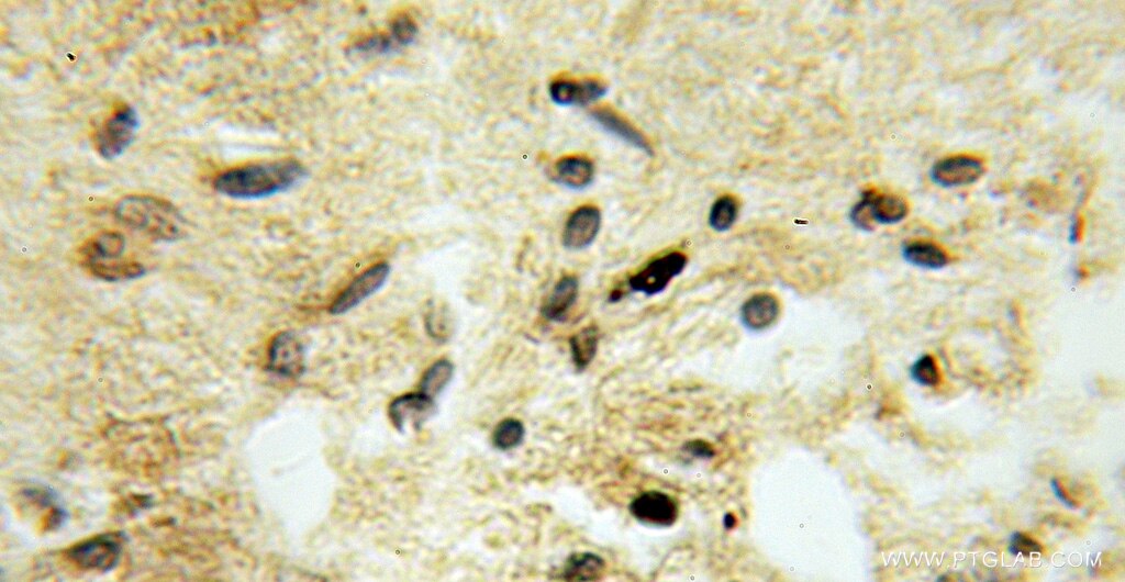 Immunohistochemistry (IHC) staining of human gliomas tissue using TSNAX Polyclonal antibody (11040-1-AP)