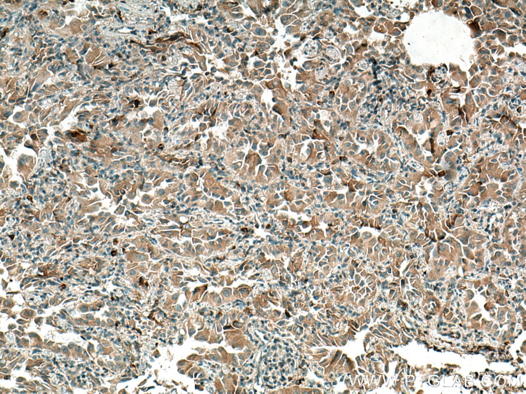 Immunohistochemistry (IHC) staining of human lung cancer tissue using Thrombospondin 1 Polyclonal antibody (18304-1-AP)