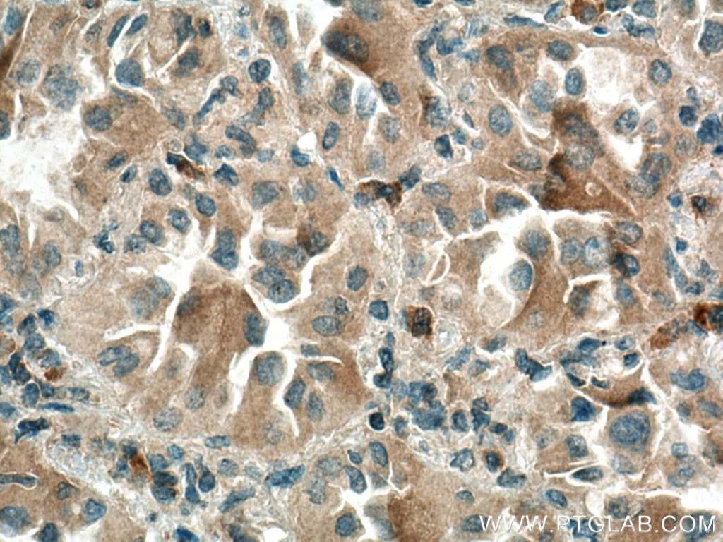 Immunohistochemistry (IHC) staining of human lung cancer tissue using Thrombospondin 1 Polyclonal antibody (18304-1-AP)