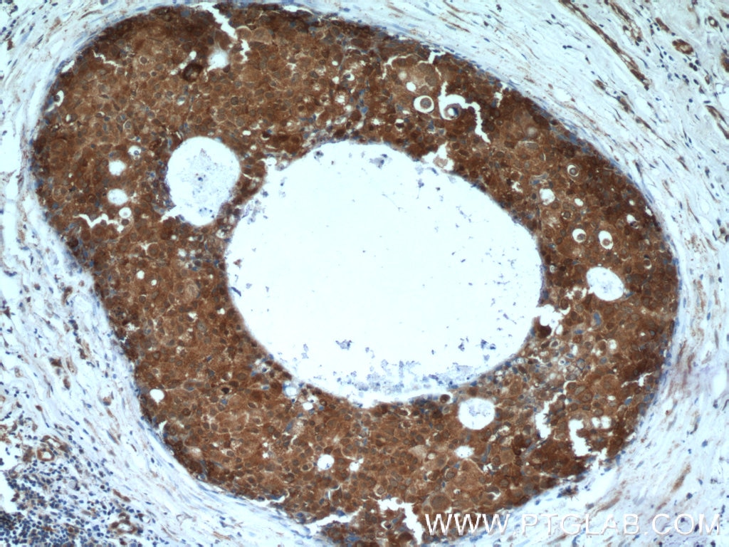 Immunohistochemistry (IHC) staining of human breast cancer tissue using TSP50 Polyclonal antibody (12574-1-AP)