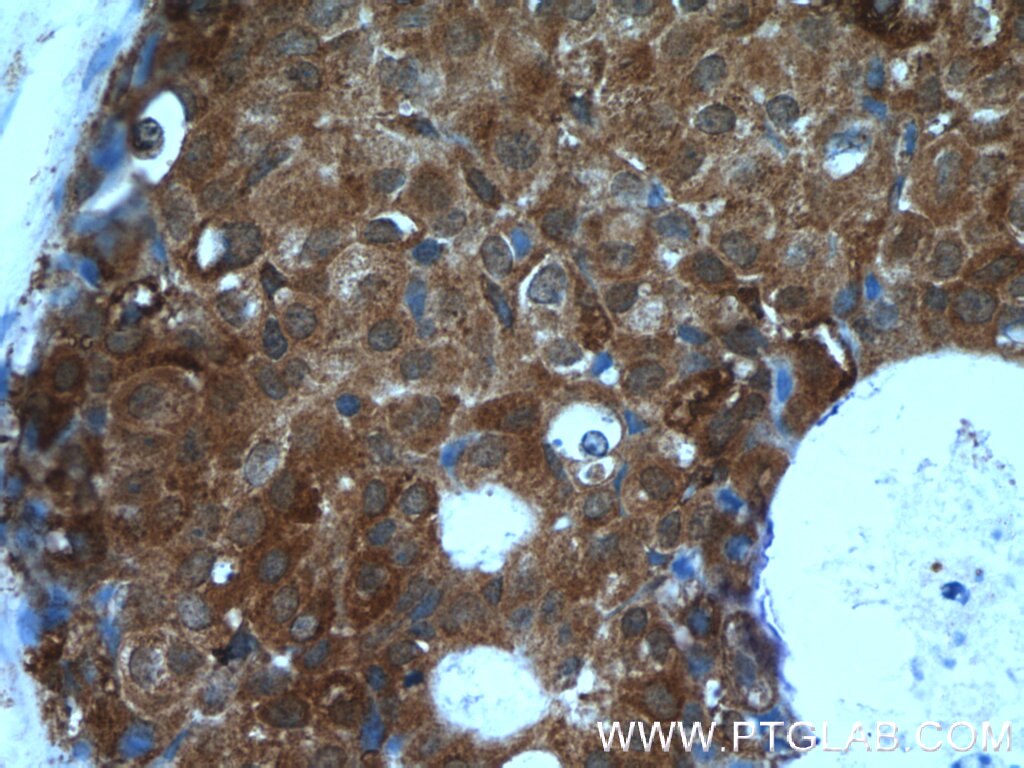 Immunohistochemistry (IHC) staining of human breast cancer tissue using TSP50 Polyclonal antibody (12574-1-AP)