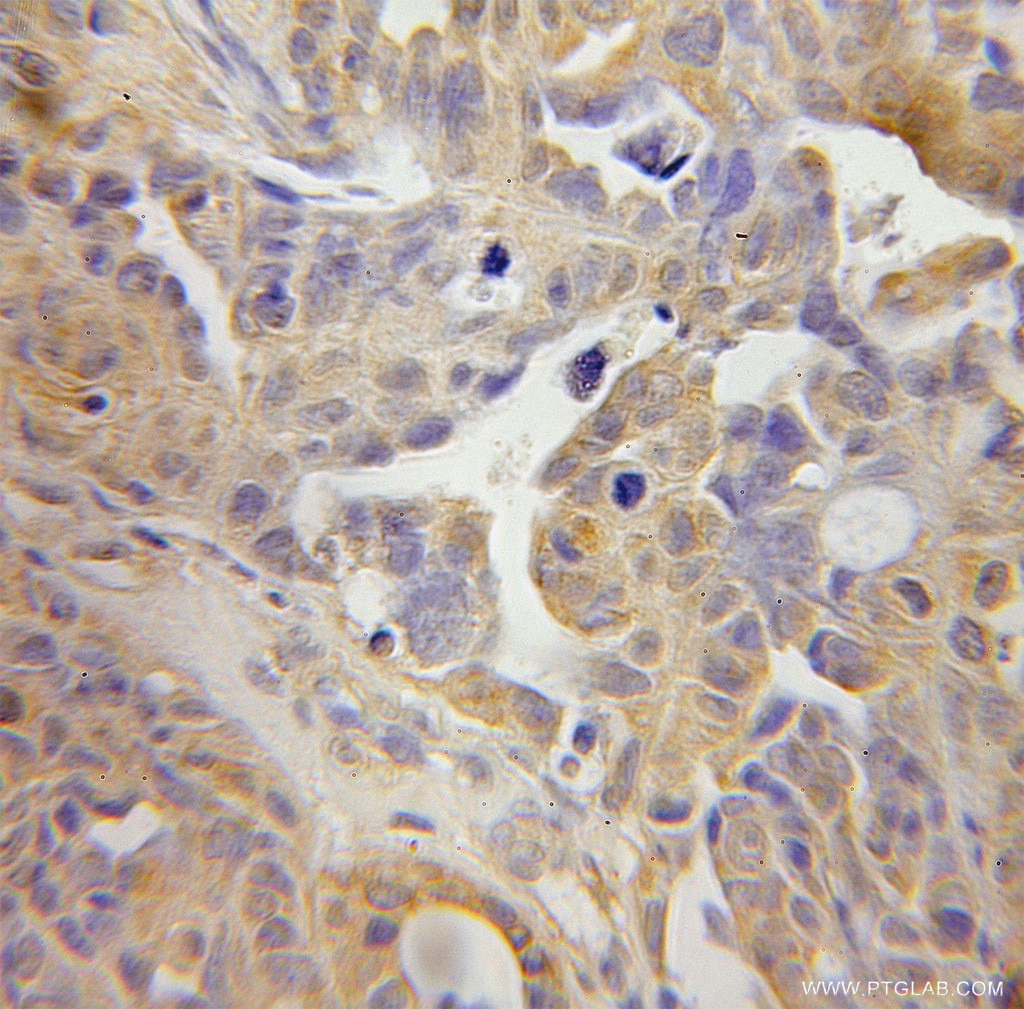 Immunohistochemistry (IHC) staining of human ovary tumor tissue using TSP50 Polyclonal antibody (12574-1-AP)