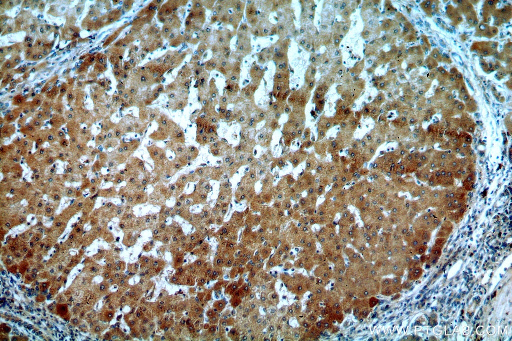 Immunohistochemistry (IHC) staining of human hepatocirrhosis tissue using TSPAN33 Polyclonal antibody (14329-1-AP)