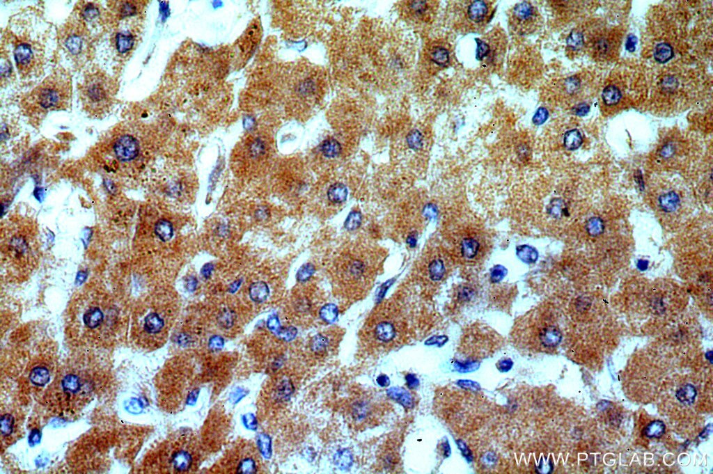 Immunohistochemistry (IHC) staining of human hepatocirrhosis tissue using TSPAN33 Polyclonal antibody (14329-1-AP)