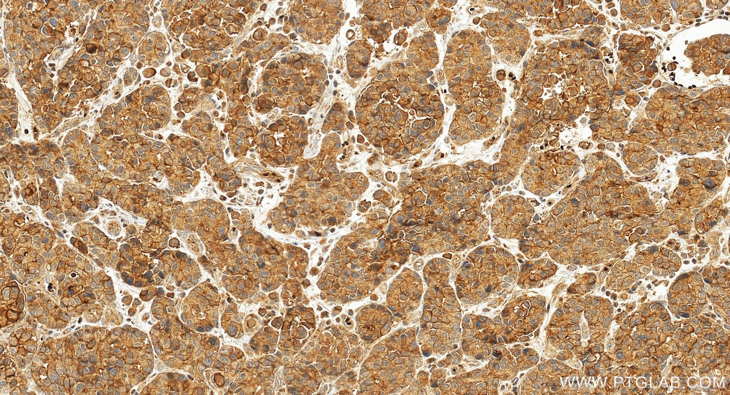 Immunohistochemistry (IHC) staining of human stomach cancer tissue using TSPAN8 Polyclonal antibody (20319-1-AP)