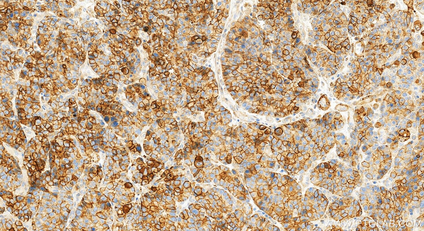 Immunohistochemistry (IHC) staining of human stomach cancer tissue using TSPAN8 Recombinant monoclonal antibody (87700-3-RR)