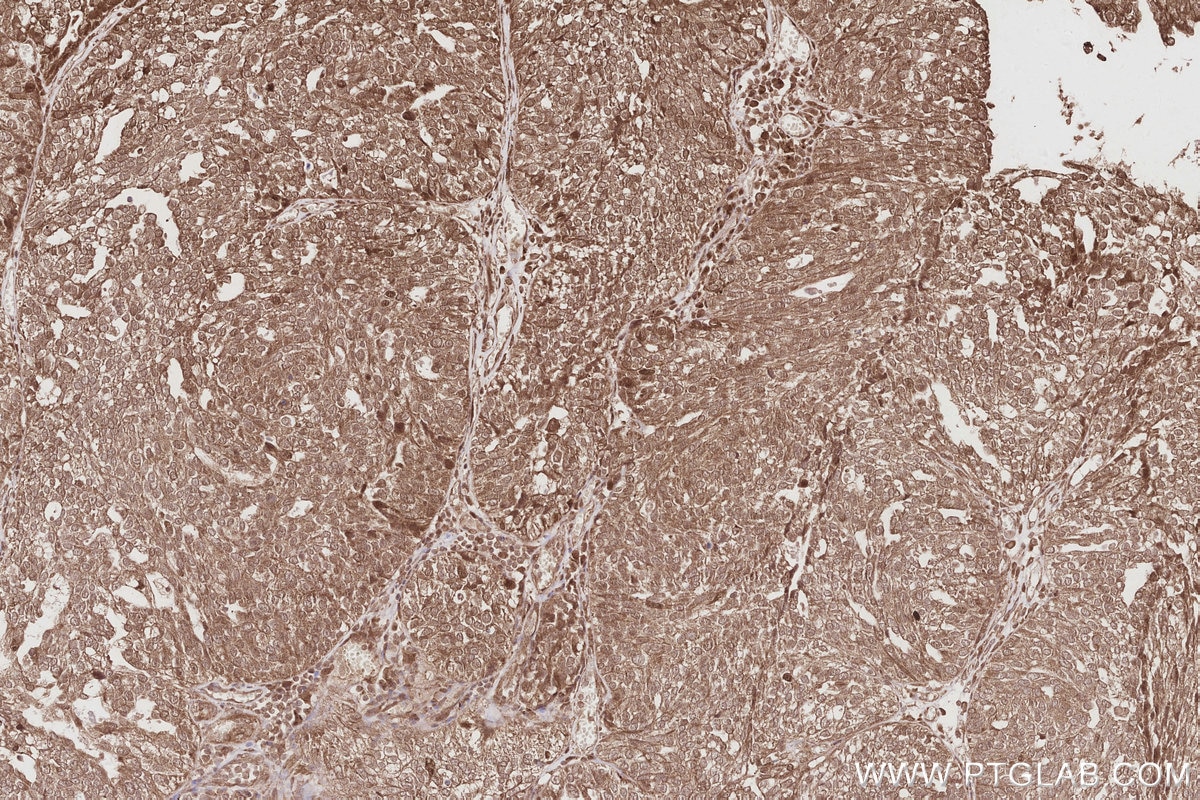 Immunohistochemistry (IHC) staining of human ovary cancer tissue using TSPYL2/CDA1 Polyclonal antibody (12087-2-AP)