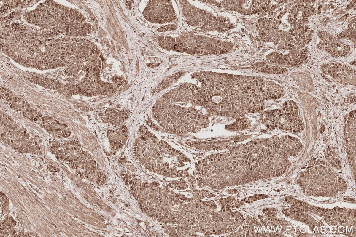Immunohistochemistry (IHC) staining of human stomach cancer tissue using TSPYL2/CDA1 Polyclonal antibody (12087-2-AP)
