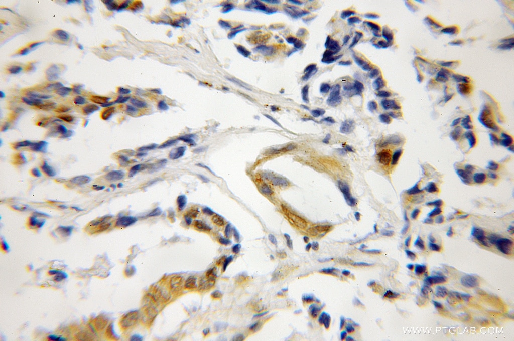 Immunohistochemistry (IHC) staining of human lung cancer tissue using CDA1 Polyclonal antibody (12087-2-AP)