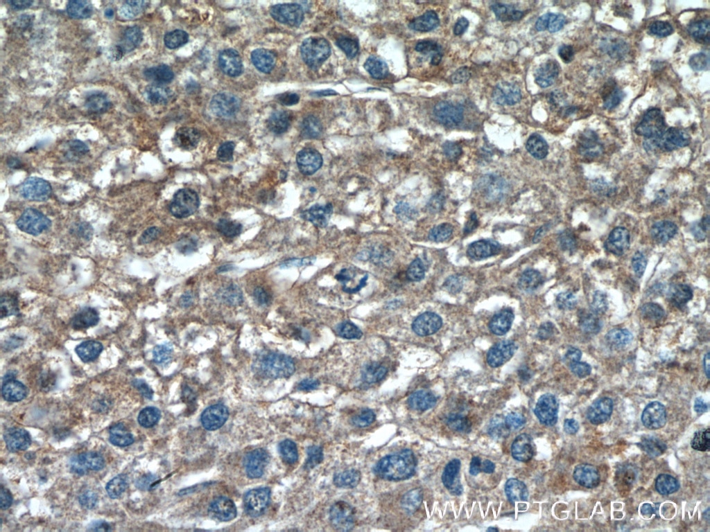 Immunohistochemistry (IHC) staining of human liver cancer tissue using TSSK3 Polyclonal antibody (12940-1-AP)
