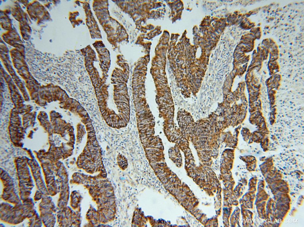 Immunohistochemistry (IHC) staining of human colon cancer tissue using TST Polyclonal antibody (16311-1-AP)