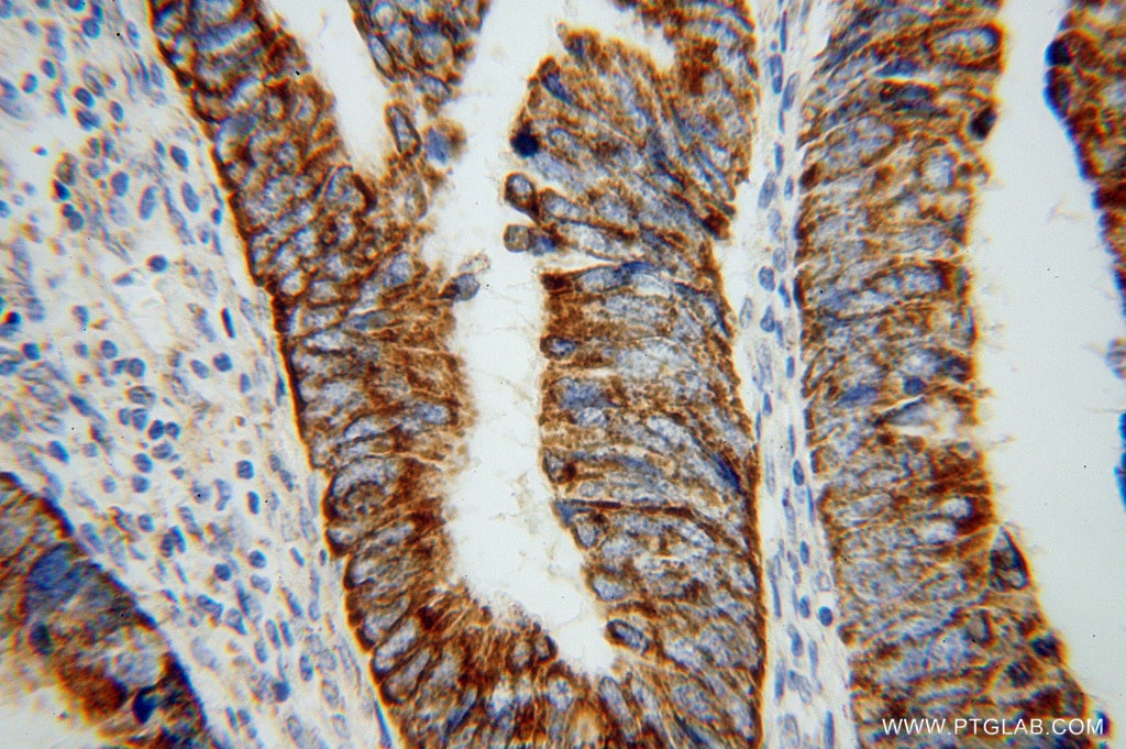 Immunohistochemistry (IHC) staining of human colon cancer tissue using TST Polyclonal antibody (16311-1-AP)