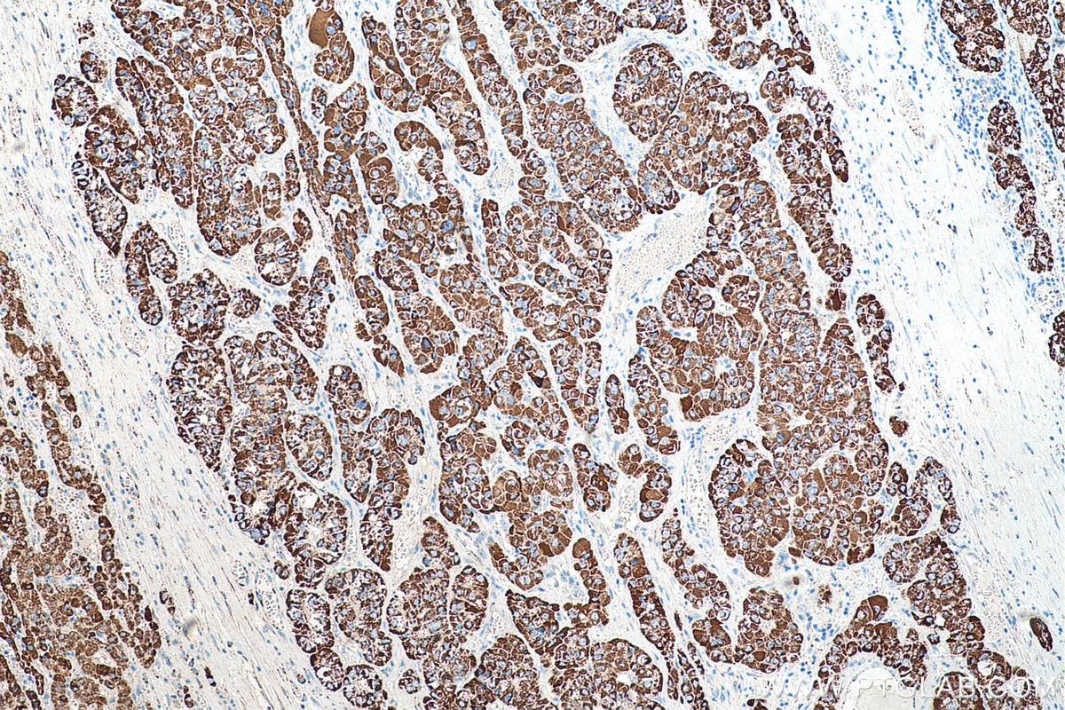 Immunohistochemistry (IHC) staining of human liver cancer tissue using TST Monoclonal antibody (66018-1-Ig)
